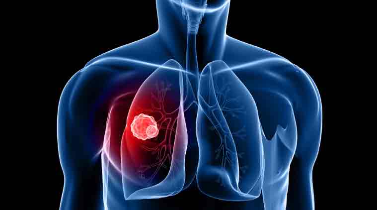 sign up for lung cancer screening Singapore