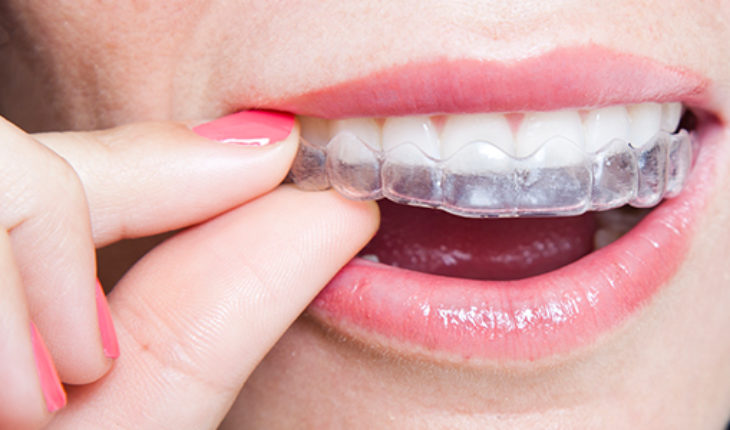 How Much Do Invisible Braces Cost in Singapore