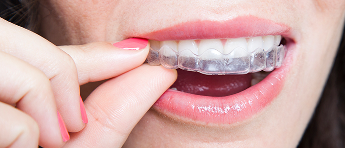 How Much Do Invisible Braces Cost in Singapore