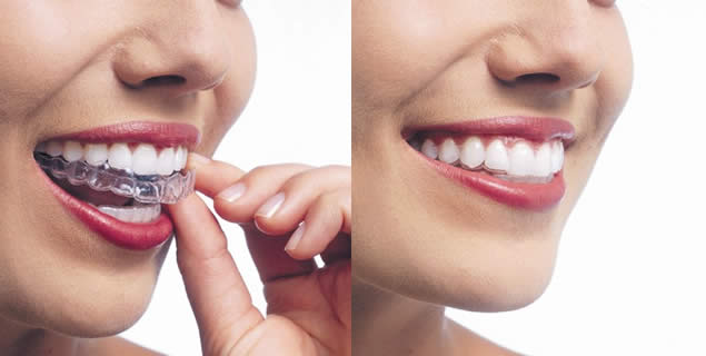 where to get invisble braces in singapore