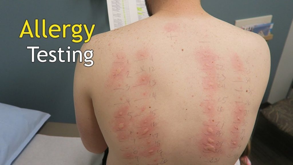 taking-a-test-can-help-you-find-skin-allergy-triggers-news-room