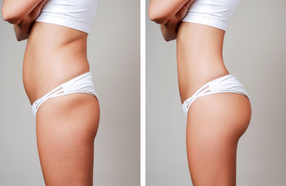 Liposuction